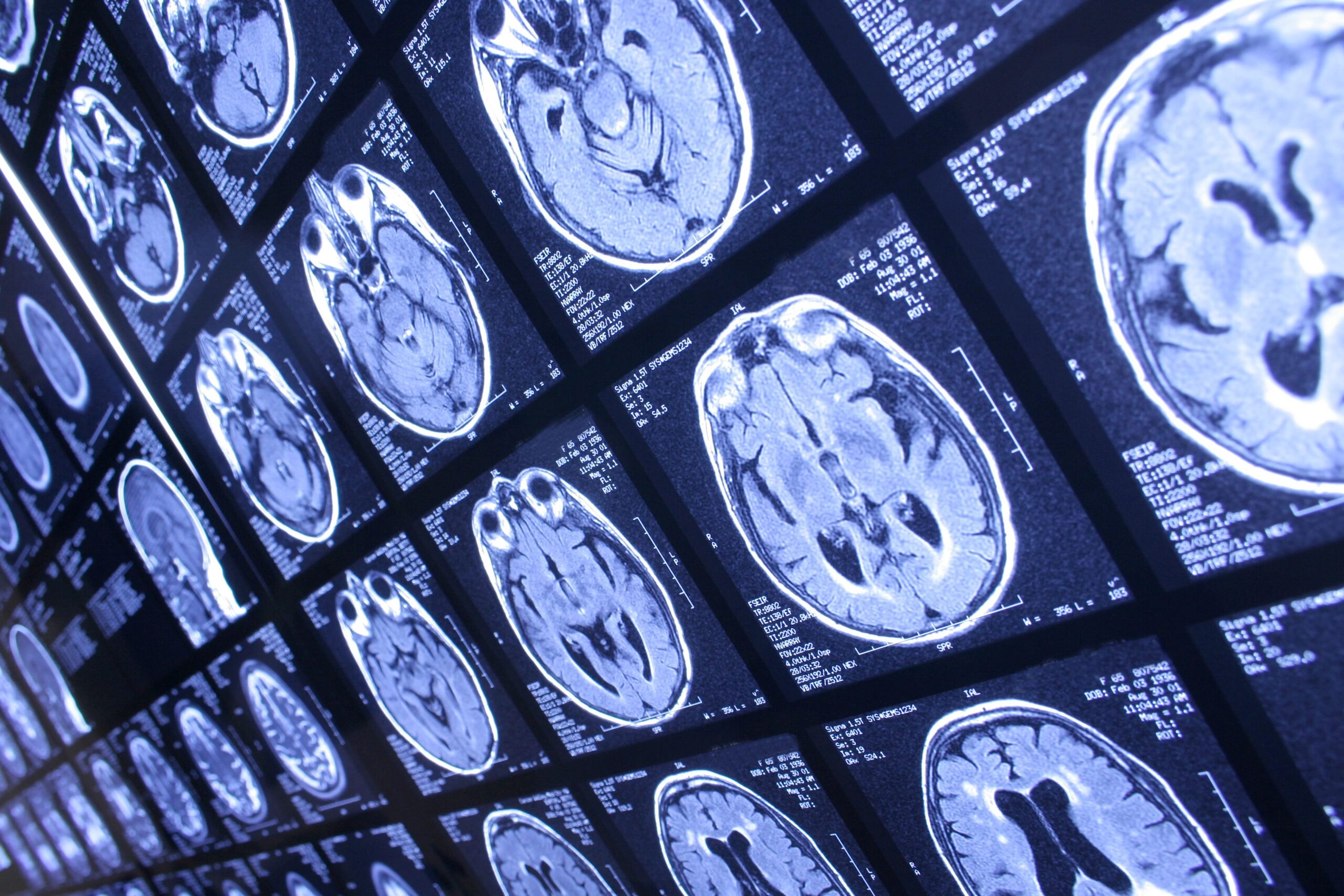 Autism research focuses on genetic factors
